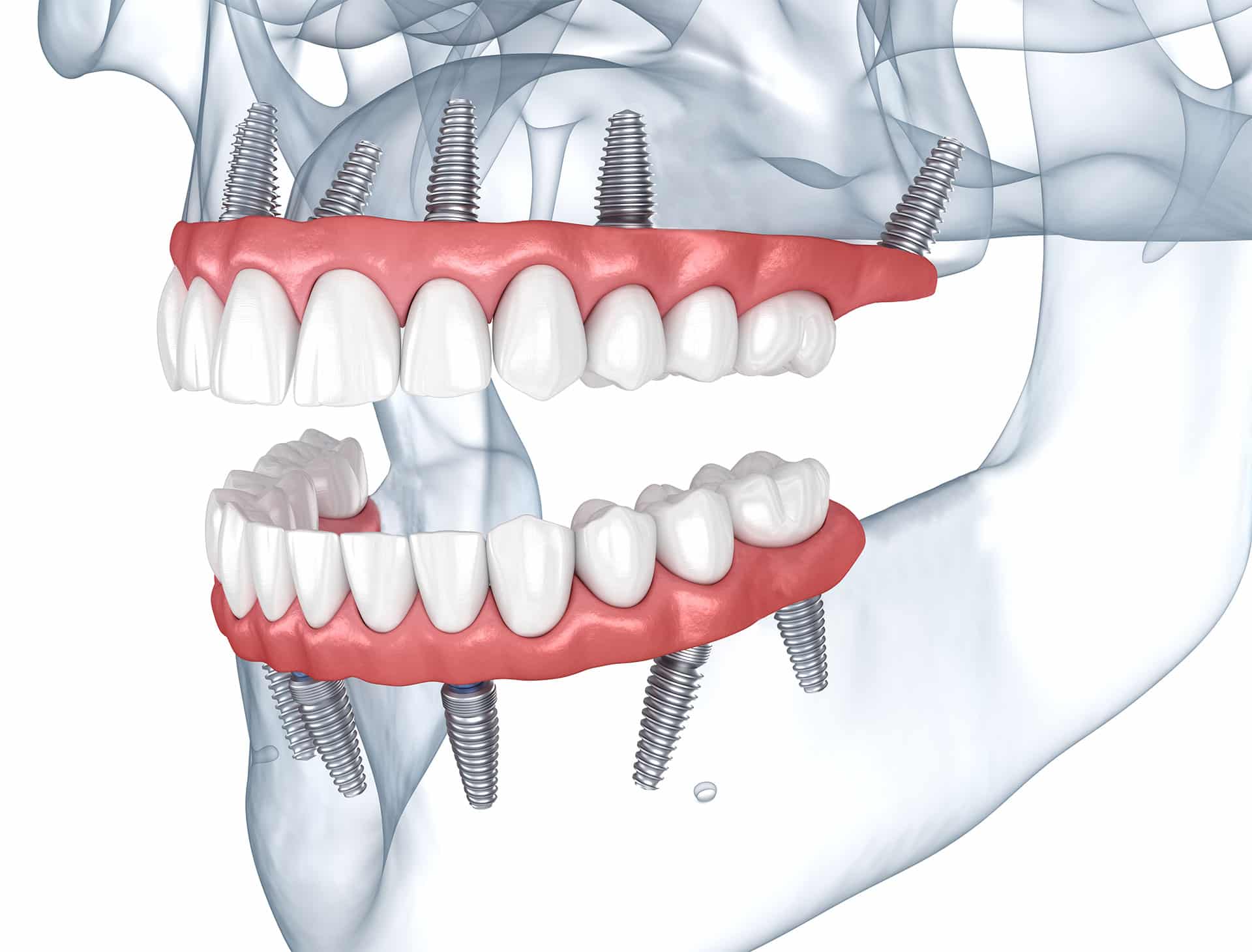dental implant treatment